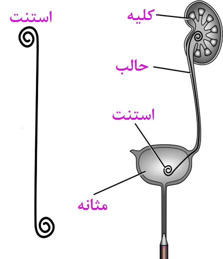 s/استنت حالب